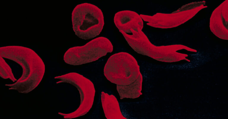 Sickle cell treatment created using gene editing wins UK approval